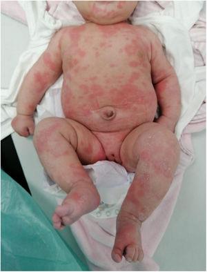 Urticaria-like exanthem in patient 2.