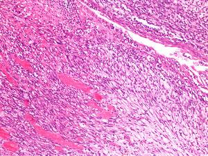 Neoplastic proliferation consisting of immature stromal cells arranged on a loose background. The ureter wrapped by the neoplasm can be seen in the right upper half of the image (haematoxylin and eosin stain, 10×).
