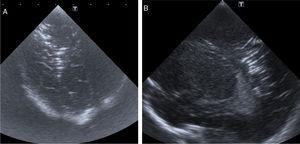 Cranial ultrasound angled coronal (A) and right sagittal (B) views showing parallel hyperechoic bands forming a semi-oval outline in the deep white matter of the right hemisphere. Features compatible with cerebral air embolism.