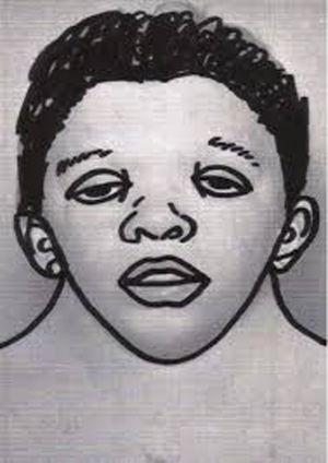Drawing illustrating the typical facial features of Noonan syndrome.