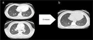 (a) Before treatment with anti-TNF-α: multiple well-delimited parenchymal nodules with a subpleural, peripheral location and a maximum diameter of 11mm. No evidence of pulmonary fibrosis. Findings compatible with stage 2 pulmonary sarcoidosis. (b) After treatment with anti-TNF-α: significant decrease in the number and size of pulmonary nodules.
