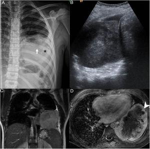 (A) Radiograph of the ribcage showing infiltration and partial destruction of the posterior shaft of the left 8th rib (white arrow) associated with a large intrathoracic, extrapulmonary soft-tissue mass with faint amorphous calcifications (*) and mild pleural effusion. (B) Ultrasound image of the heterogeneous mass in the thorax. (C) T2-weighted magnetic resonance imaging (MRI), coronal plane and (D) intravenous contrast-enhanced, fat-saturated T1-weighted MRI, transversal plane, showing a lobulated mass in contact with the mediastinal, pericardial, axillary and diaphragmatic pleura with peripheral enhancement (arrow point) and necrosis in the central area.