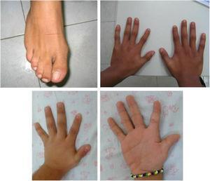 Finger and toe abnormalities in cases 3 and 4.