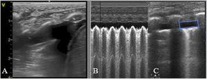 Pleural effusion. (A) Jellyfish sign, secondary collapse caused by pleural effusion (anechoic contents). (B) Sinusoid sign (M-mode), generated by the movement of the lung toward the parietal pleura with inspiration. (C) Quad sign (2D-mode): rectangular shape in which the anechoic area corresponds to the effusion, demarcated by the visceral pleura (below) and the parietal pleura (above) and on the sides by the shadows of a rib or the diaphragm.