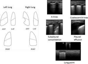 Protocol for 6-zone lung ultrasound examination and figures used in the learning module.