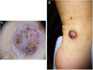 A) Dermoscopy image: pseudovascular lesion. B) Irregular dome-shaped lesion with bright erythematous coloration.