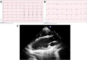 (A) Resting 12-lead ECG, patient 1. (B) Resting 12-lead ECG, patient 2. (C) Echocardiogram, patient 1. Long axis view showing posterior and rightward deviation of the apex of the left ventricle.