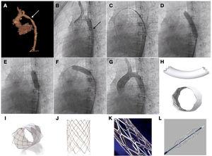 Patient aged 10 years with Williams syndrome and recurrent coarctation of aorta referred for percutaneous stent implantation. (A and B) CT and angiography images showing narrowing of the aortic lumen. (C) Advancing the stent to the target area. (D) Inflation of stent with visualization of reduced expansion at the level of the isthmus. (E and F) Post-dilation of both the distal and the proximal portions of the stent. (G) Angiographic verification. (H) BeGraft stent. (I) Covered CP stent. (J) CP stent (uncovered). (K) Palmaz Genesis stent. (L) Formula stent.