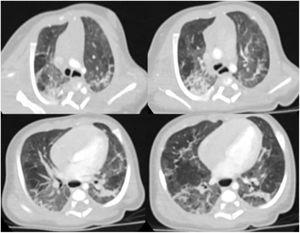 Computed tomography of the chest. Bilateral pulmonary ground glass opacity suggestive of infiltration, areas of consolidation compatible with atelectasis and predominantly smooth interlobular septal thickening.