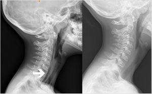 Left: lateral cervical radiograph evincing the presence of ectopic air in the retropharyngeal space (white arrow). Right: lateral cervical radiograph obtained 15 days later showing near-full resolution of abnormal features.