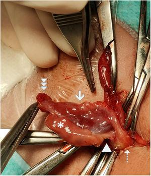 Intraoperative photograph. The ovary (white asterisk), ovarian ligament (white arrow head), Fallopian tube (solid white arrow), fimbriae (triple arrowhead) and uterus (dotted white arrow) were contained in the hernial sac, which is referenced with haemostat forceps.