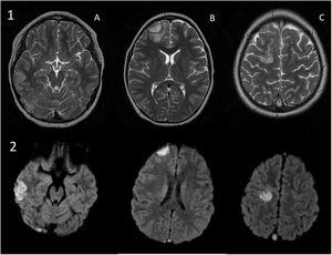 a) Axial view, T2-weighted image: signal hyperintensity compatible with cortical haematoma and oedema in the right temporal (A) and frontal (B) regions (B). Signal hyperintensity compatible with oedema in the right superior frontal gyrus (C). b) Axial views in diffusion-weighted imaging: restricted diffusion in the respective lesions.