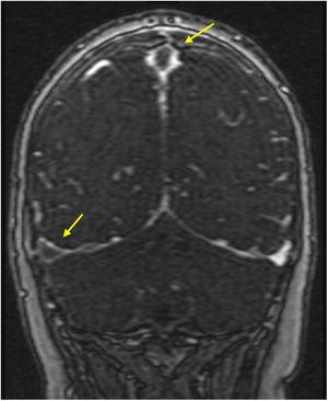 Coronal view, post-gadolinium T1-weighted image showing thrombosis of the superior sagittal sinus and right transverse sinus (arrows).