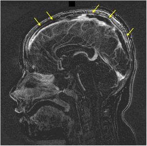 Sagittal view of MR venography sequence evincing lack of flow in the superior sagittal sinus, compatible with thrombosis (arrows).
