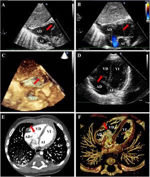 A. Echocardiogram, subcostal view, patient 1. B. Echocardiogram, subcostal view, patient 1. Right-to-left shunt through patent foramen ovale (blue flow). C. 3D echocardiogram, subcostal view, patient 1. D. Echocardiogram, 4-chamber view, patient 1. E-F. CT angiography, patient 4. CT, computed tomography; LA, left atrium; LV, left ventricle; RA, right atrium; RV, right ventricle. Red arrow: Chiari network.