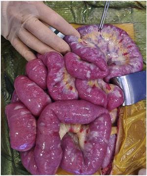 Intraoperative macroscopic image of the small intestine showing whitish atrophic plaques with necrotic lesions throughout the ileum, peritoneum and appendix. There is also a visible perforation in the distal ileum (marked with clamps, top of the image).