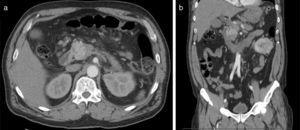 Contrast-enhanced abdominal CT – images of the lesion in the head of the pancreas – hipervascular well delineated lesion on the head of the pancreas – (a) axial and (b) coronal.