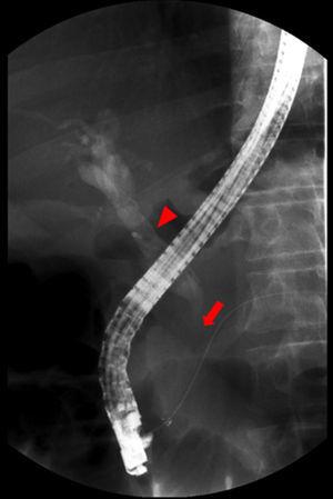 Endoscopic retrograde cholangiopancreatography – the obstruction (arrow) and marked dilatation of main bile duct (arrowhead).