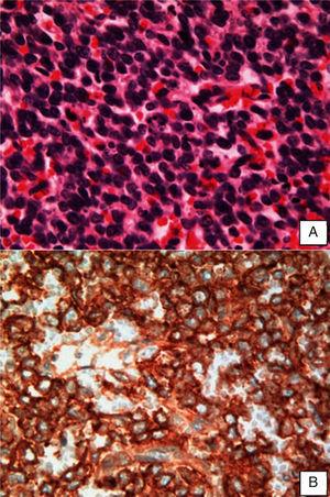 Imagem representativa da histologia de SE renal – A. 400x HE ‐ células de núcleo redondo e basofílico, com cromatina condensada e escasso citoplasma. B. 400x CD99 positivo.