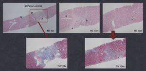 Biopsia hepática (nódulo do segmento VI/VII) guiada por TC – lesão constituída por hepatócitos morfologicamente normais, formando nódulos regenerativos separados por septos conjuntivos espessos (A) contendo vasos (arteriais e venosos) (B), reação ductular marginal (C) e infiltrado inflamatório mononuclear (D) (HE x40‐100).