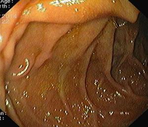 Follow-up endoscopy showed no signs of duodenal varices.