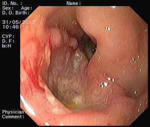 Excavated ulcer with elevated irregular borders, in the antero-inferior wall of duodenal first portion.