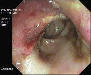 Ulcerated mass in the sigmoid colon.