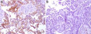 Immunohistochemistry staining was positive for Ber-EP4 (A) and negative for the anti-calretinin antibody (B).