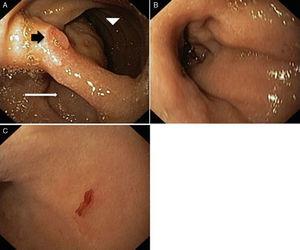 Endoscopic images of an intraluminal duodenal (“windsock”) diverticulum within the second portion of the duodenum. (A) Duodenum with a double lumen: white arrow – diverticular lumen; arrow head – true duodenal lumen; black arrow – septum with major papila. (B) Diverticular lumen with apical fresh blood oozing. (C) Punctiform lesion with oozing bleed in the diverticular mucosa.