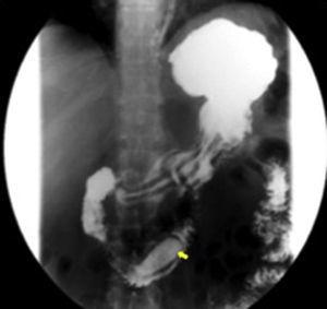 Image of esophagogastroduodenal transit with barium showing a barium filled saccular structure (yellow arrow), in the second portion of the duodenum extending to the third portion, surrounded by a radiolucent line which corresponded to the true duodenal lumen.