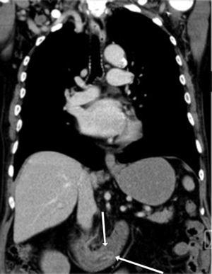 Abdominal computed tomography image (coronal plane) showing the appearance of a bowell loop within another bowell loop (white arrows). This finding, also known as the halo sign, was compatible with an intraluminal duodenal diverticulum.