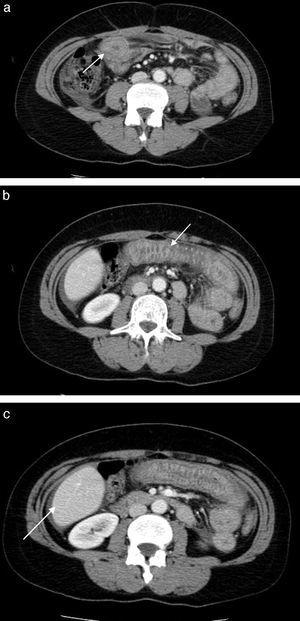 Abdominal computed tomography with oral and intravenous contrast revealing thickening of a jejunal segment, with submucosal edema (arrows) giving a so-called “target-sign” appearance (images a and b). Image (c) shows moderate ascites (arrow).
