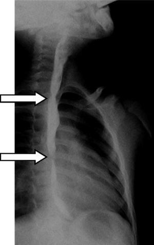 Esophagogramm, das die genaue Lage und das Ausmaß der Stenose zeigt (Pfeile).