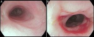 Endoskopisk aspekt af den esofageale slimhinde efter stentfjernelse (A - distal stenose; B - proximal stenose).