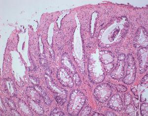 Mucosal Prolapse Polyp Mimicking Rectal Malignancy: A Case Report | GE ...