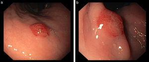 (a and b) Endoscopic findings, revealing two reddish, round and elevated lesions in the greater curvature of proximal body (a) and in the lesser curvature of distal body (b).
