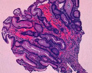 Hematoxylin and eosin stain showing spindle cell proliferation in the submucosa.