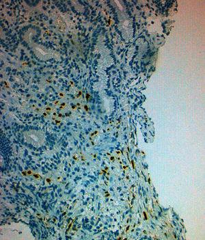 Immunohistochemical stain for human herpes virus 8 showing a diffusely positive latent nuclear antigen staining of the spindle cells, confirming the diagnosis of diffuse visceral Kaposi's sarcoma.