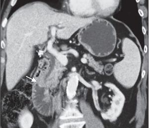 Computed tomography showed an ampullary mass with 13mm suggestive of ampullary adenoma.