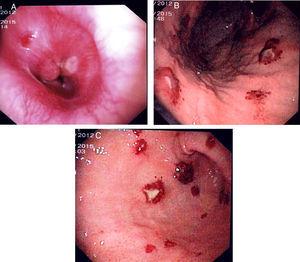 (A) Upper endoscopy showing in the esophagus–gastric transition a violacea and papular lesion. (B and C) Upper endoscopy showing fundus, body and antrum of the stomach with multiples patchy, raised, erythematous and hemorrhagic lesions with 8mm of diameter.