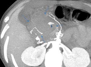 Pseudoaneurysm with active bleeding (triangle) within the peripancreatic collection (arrows) (abdominal CT, arterial phase, maximum intensity projection reformation).
