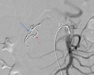 Embolization with two coils in the gastroduodenal artery (blue arrow) and in a branch of the superior mesenteric artery (red arrow) (first angiography).