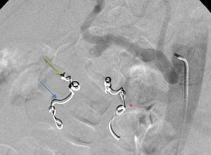 A third coil was inserted in the gastroduodenal artery with successful embolization of this vessel (green arrow) (second angiography).