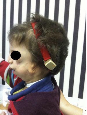 Hearing rehabilitation in Treacher Collins Syndrome with bone anchored ...