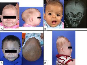 Diagnosis of infant synostotic and nonsynostotic cranial deformities: a ...