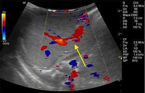 Abdominal ultrasound with Doppler. The arrow indicates the portosystemic shunt.