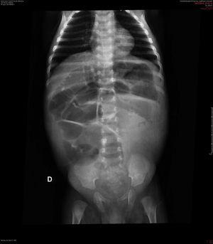 Simple abdominal radiography of a 2-month-old patient with total colon aganglionosis. Preoperative image shows dilated loops of the small bowel and colon, and low volume of air in the colon region.