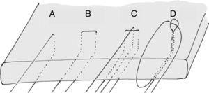 Diferentes configuraciones de sutura del tendón. A) punto simple; B) punto horizontal; C) punto modificado de Masson-Allen; D) punto lasso loop. Los puntos c y d son más fuertes que los puntos a y b (Hapa et al.39).