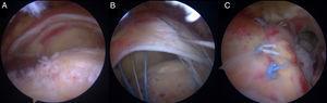 Rotura en cuarto de luna del supraespinoso (A). Tras la preparación de la huella ósea y colocación de los implantes, se pasan las suturas a través del tendón (B) y se anudan (C).