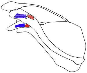 Dibujo que muestra las inserciones del ligamento coracoclavicular (las inserciones claviculares se plasman en la zona superior en correspondencia con la zona inferior). Las inserciones del ligamento conoide (marca roja) se encuentran en la parte posteromedial de la raíz de la apófisis coracoides y en el tubérculo conoide (zona punteada) de la clavícula. Las inserciones del ligamento trapezoide (marca azul) se encuentran en el borde interno del ángulo de la coracoides y en la clavícula se inserta en la línea rugosa (zona con líneas) que se encuentra lateral y anterior respecto al tubérculo conoide.